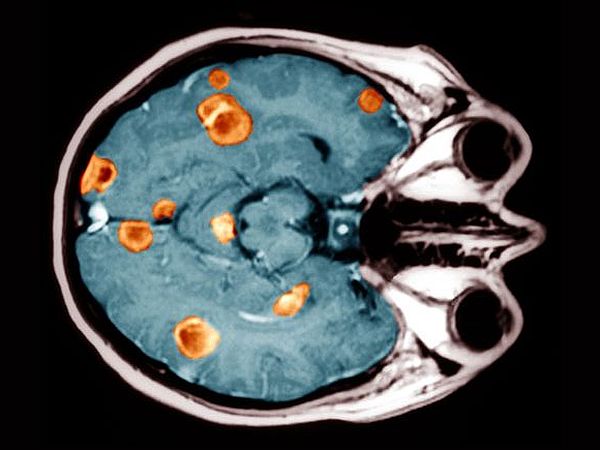 Метастазы рака в головном мозге