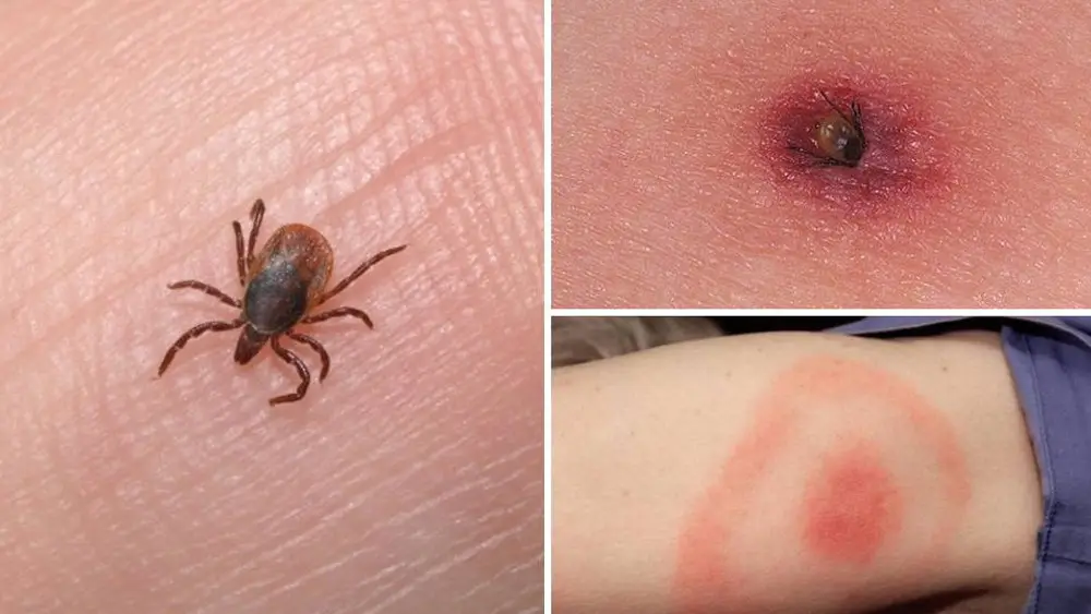 Начался сезон активности клещей. Как защититься от вируса, поражающего нервную систему?