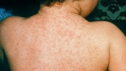 В Кыргызстане продолжают расти показатели кори. Эпидемиолог рассказала, как защитить себя от опасного заболевания (интервью)